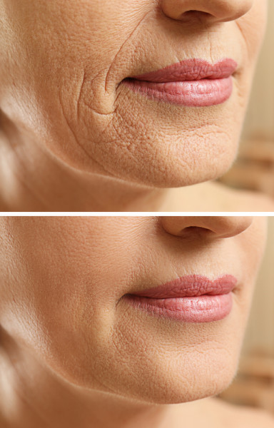 Best Anti Wrinkle Treatments Fab Fashion Fix   Shutterstock 542210917 192x300@2x 